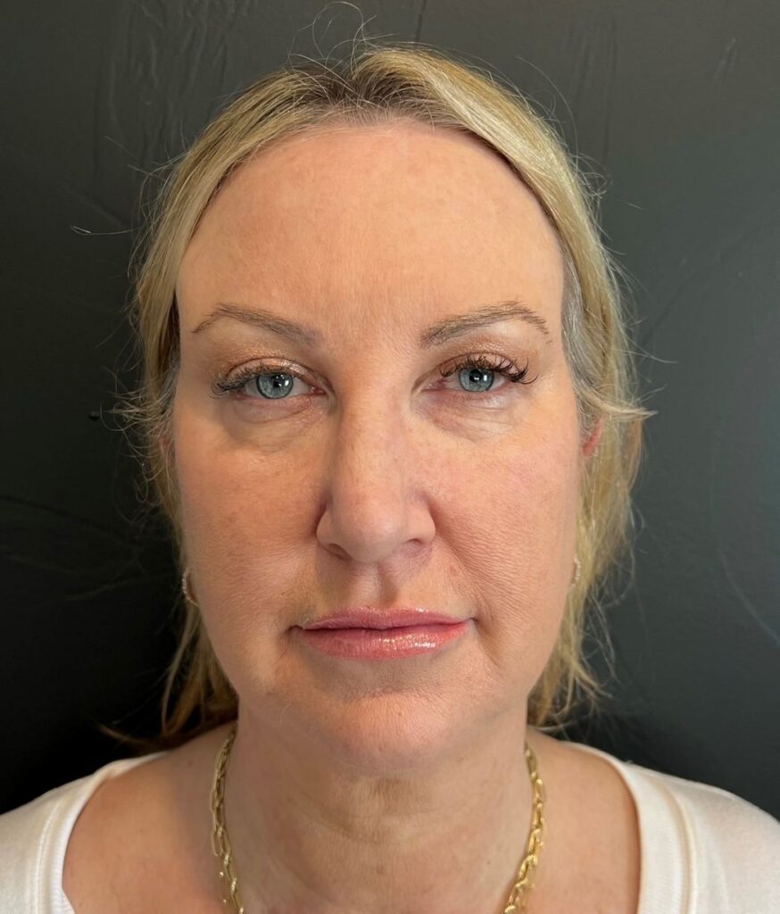 EMFACE, Patient 2 Juniper Face + Figure