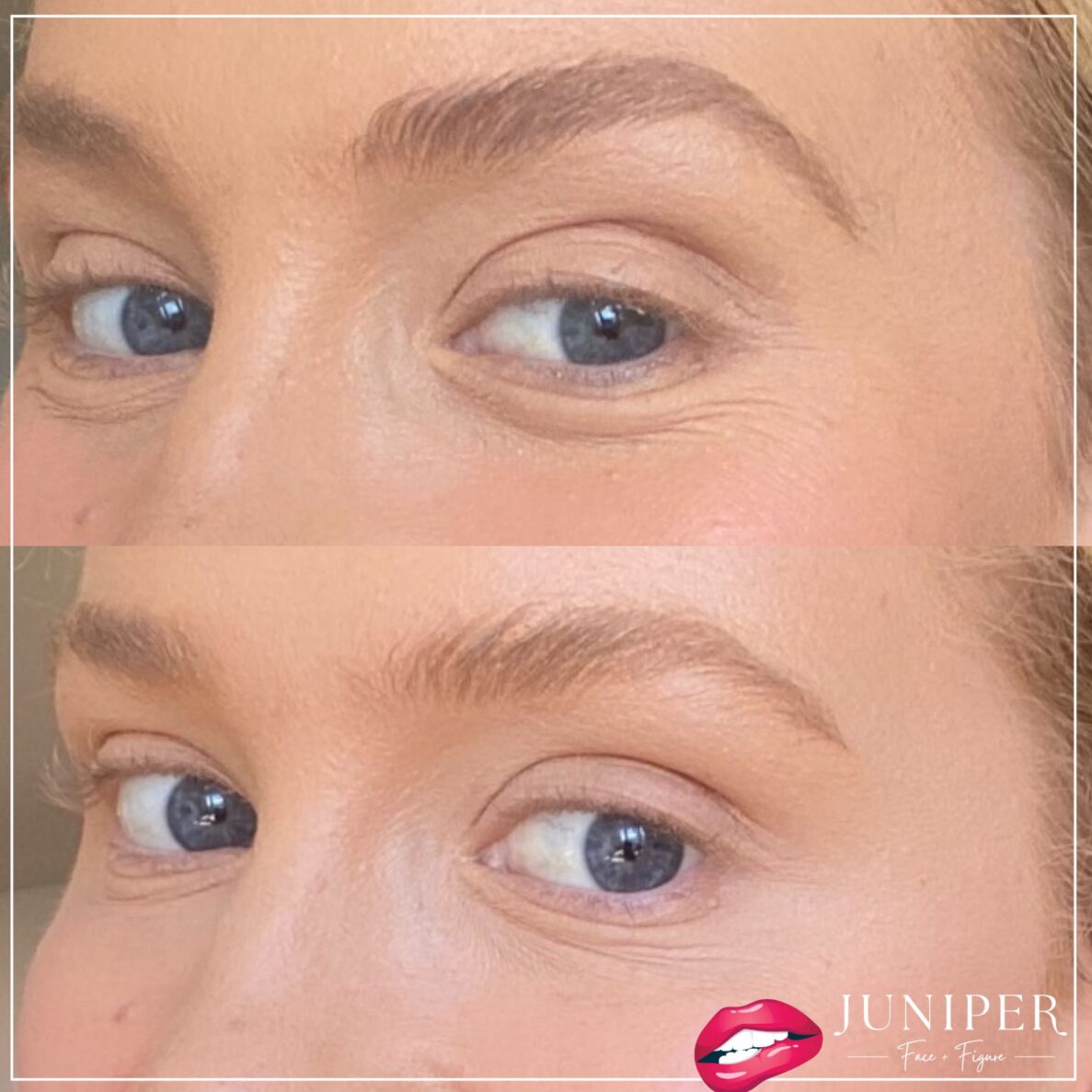 Fine Lines Underneath Eyes, 1 Juniper Face + Figure