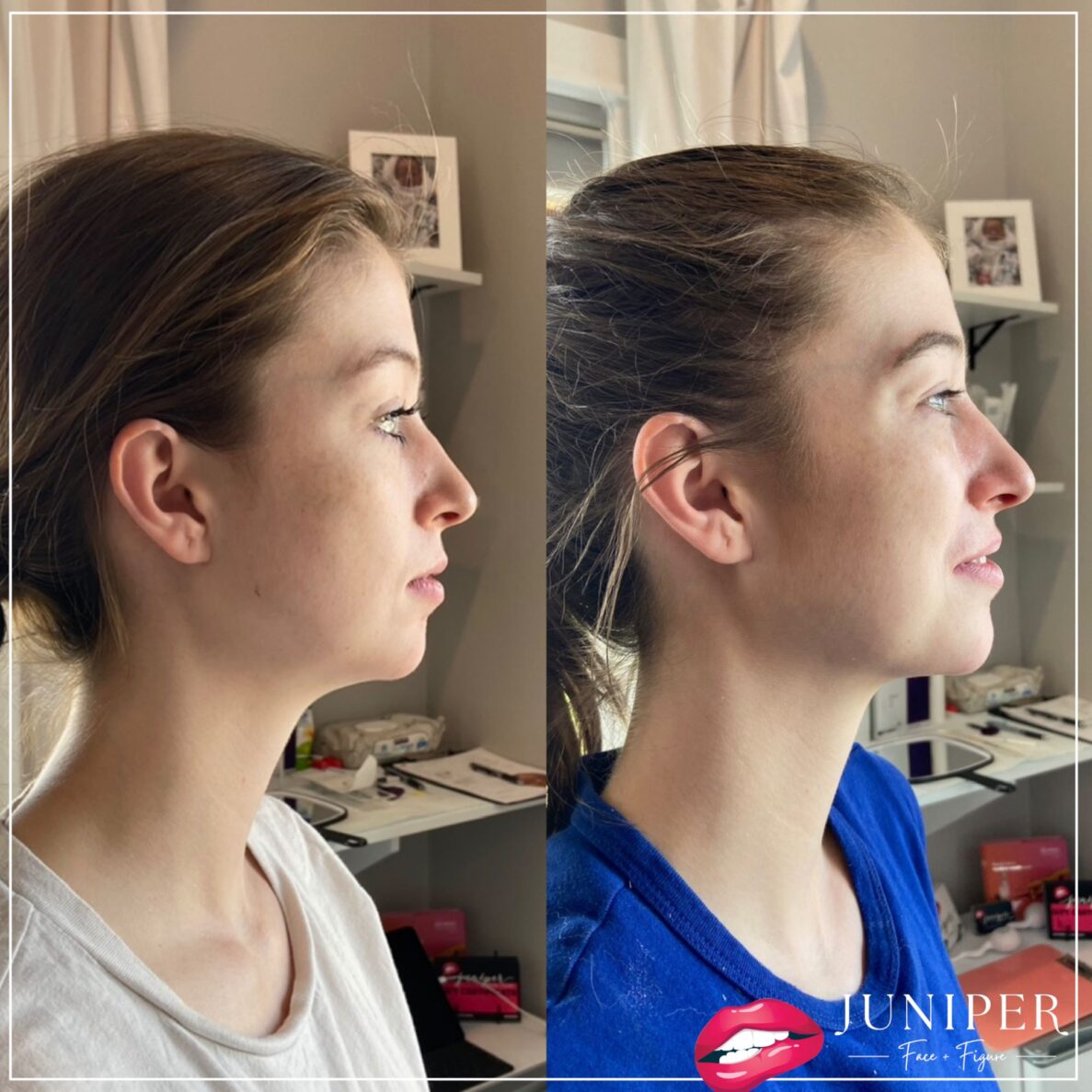 Chin enhancement 2 juniper face figure