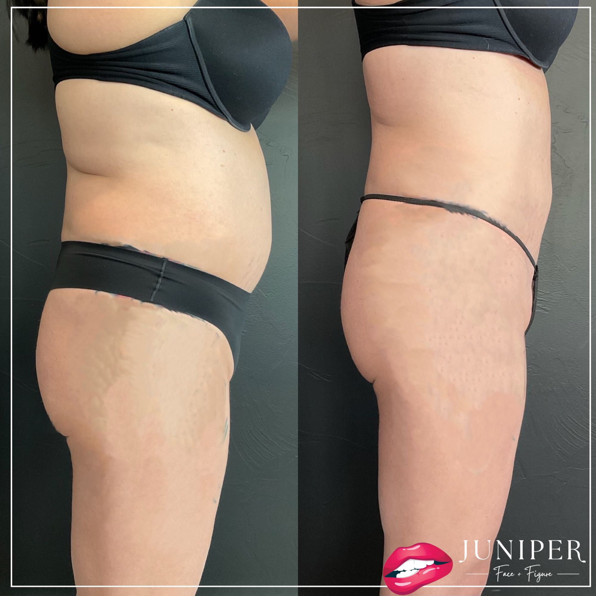 From Ranch to Runway: Shape Your Bozeman Body with Juniper Face + Figure’s  Cutting-Edge EMSCULPT Technology