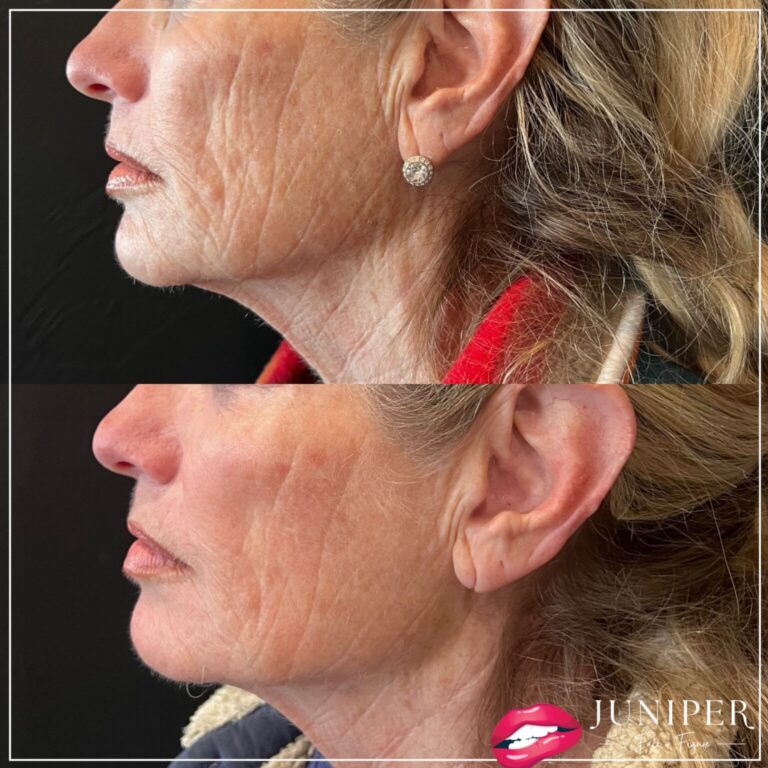 Before and after of Radiofrequency Microneedling