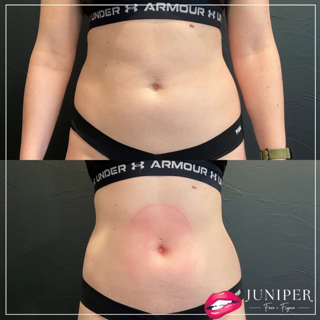 Before EMSCULPT NEO and after using EMSCULPT NEO on abdomen