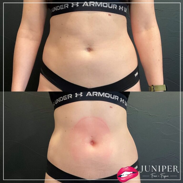 Before EMSCULPT NEO and after using EMSCULPT NEO on abdomen