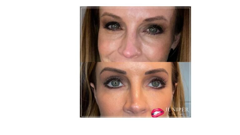 Female under eye filler before and after