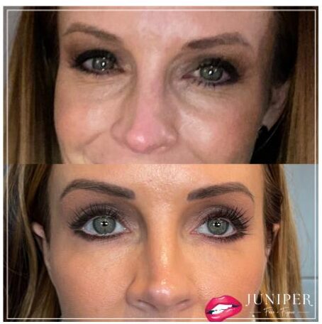 Female under eye filler before and after