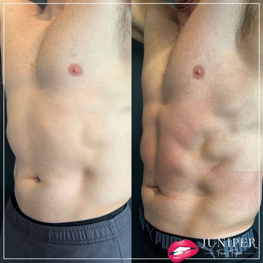 Before and after male abdomen showing favorable results.